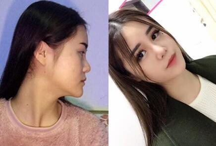 北京米扬丽格医疗美容医院怎么样?隆鼻多少钱?下图是隆鼻整形前后对比图: