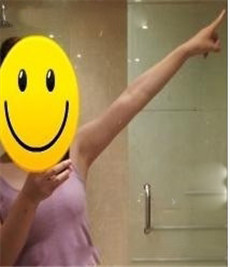 大家看看我在北京丽都陈万芳医生做的手臂吸脂怎么样