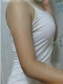 大家看看我在北京丽都陈万芳医生做的手臂吸脂怎么样