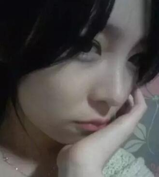 我的假体隆鼻恢复过程,有图有真相哦~