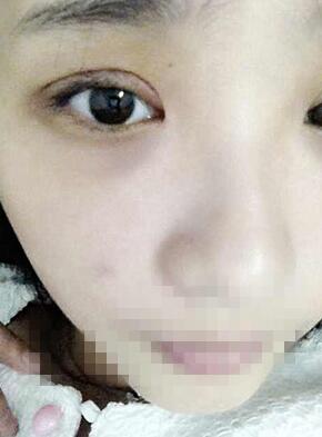 双眼皮恢复过程经历