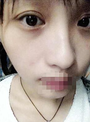 双眼皮恢复过程经历