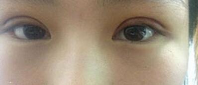 全切双眼皮十天啦~来看看我的果