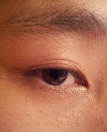 八大处靳小雷埋线双眼皮一个多月了，果很好哦~~~