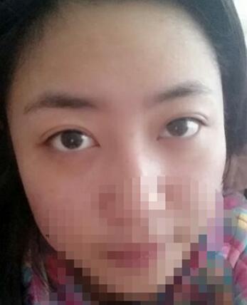 八大处靳小雷埋线双眼皮一个多月了，果很好哦~~~