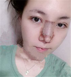 米扬丽格巫文云做的鼻部修复，恢复得不错了