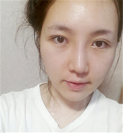 米扬丽格巫文云做的鼻部修复，恢复得不错了