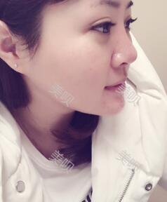 董薇薇医师为我做的玻尿酸垫下巴术前术后对比照