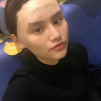 美圣美医院任志伟为我做的自体脂肪面部填充恢复过程