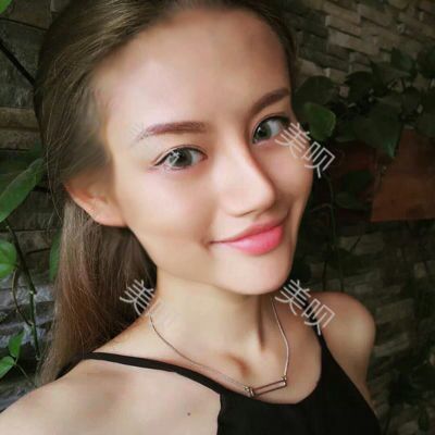 美圣美医院任志伟为我做的自体脂肪面部填充恢复过程