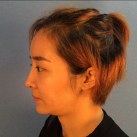 自体脂肪面部填充后我的部看上去好自然宛若天生