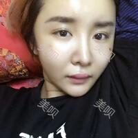 自体脂肪面部填充后我的部看上去好自然宛若天生