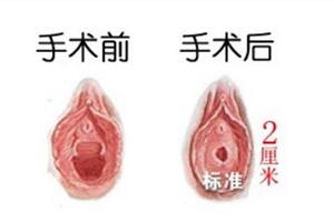 感谢范建辉医生给我做的私密整形手术让我又成功抓住了老公的心