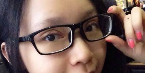 全切双眼皮+去皮去脂+开眼角一个月了~