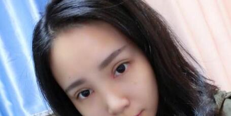 全切双眼皮+去皮去脂+开眼角一个月了~