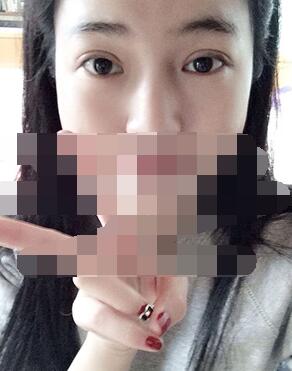 做埋线双眼皮一周啦~果满满的！