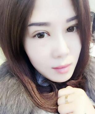 双眼皮恢复记录 果很满意~