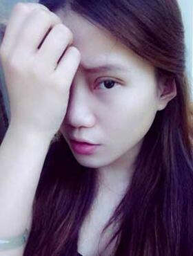 割双眼皮半个月了 有双眼皮的感觉真爽！