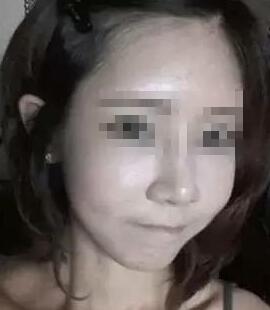 假体隆鼻+面部填充手术20天康复记录