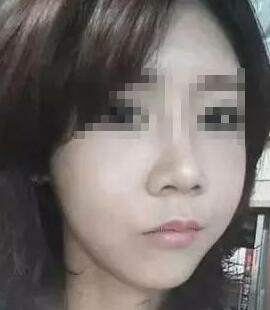 假体隆鼻+面部填充手术20天康复记录