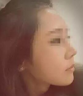 假体隆鼻+面部填充手术20天康复记录