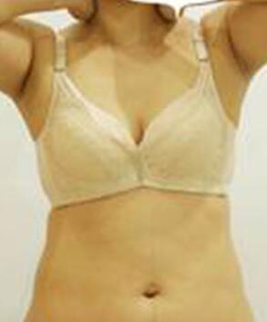 腰部吸脂 水桶腰变成小蛮腰啦