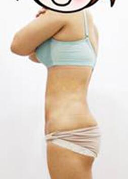 腰部吸脂 水桶腰变成小蛮腰啦