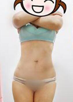 腰部吸脂 水桶腰变成小蛮腰啦