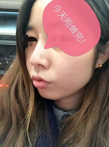 做了玻尿酸注射隆鼻 感觉很不错