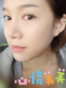 光子嫩肤 我的皮肤也可以白皙Q弹啦~