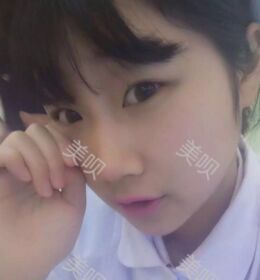 做了切开双眼皮之后气质都不一样了