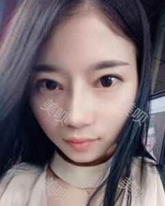 张中锋做的隆鼻整形真的精致漂亮