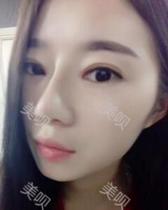 张中锋做的隆鼻整形真的精致漂亮