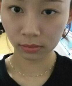 去北京301医院整形美容科做了颧骨内推大家快来围观啦