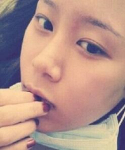 去北京301医院整形美容科做了颧骨内推大家快来围观啦