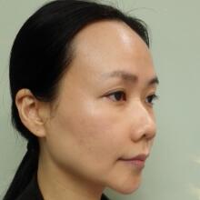 面b提升手术价格和真人案例