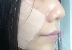 面部紧致埋埋蛋白线.提升恢复第二天