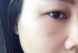 埋埋蛋白线.提升后脸部很平整光滑