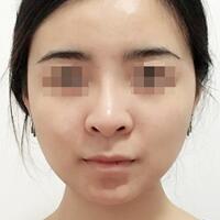 下颌角手术费用和案例