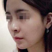 下颌角手术费用和案例