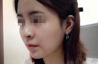 下颌骨削骨瘦脸整形手术真实案例多图对比分享