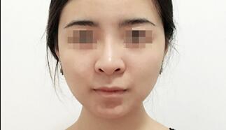 下颌角削骨瘦脸手术很成功