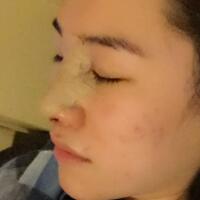 硅胶假体隆鼻和鼻翼缩小隆鼻整形花费15800元