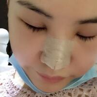 硅胶假体隆鼻和鼻翼缩小隆鼻整形花费15800元