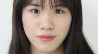 隆鼻整形包括假体隆鼻和鼻翼缩小，费用一共为15800元