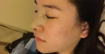 隆鼻整形术后恢复图