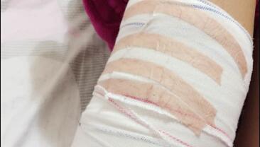 四川娇点美容整形医院的罗通贵院长给我做的吸脂瘦手臂手术