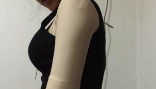 吸脂减肥瘦手臂，甩掉蝴蝶袖告别粗手臂真实案例分享