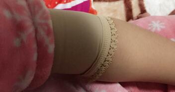 吸脂减肥瘦手臂，甩掉蝴蝶袖告别粗手臂真实案例分享