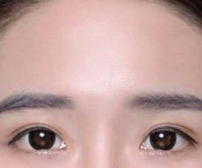 郑东学做的双眼皮果你来评价